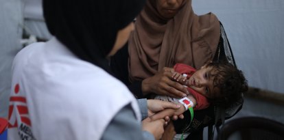 Fotografía tomada el 11 de julio en la ciudad de Gaza de Nour Al-Shaer, de ocho meses de edad, con desnutrición grave.
