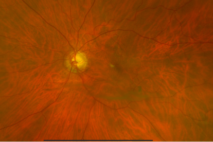 Imagen muestra perdida de fibras del nervio óptico provocado por el glaucoma.