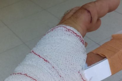 La mano del hombre vendada tras ser curado de las heridas provocadas por el perro.
