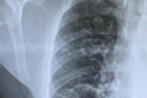 Radiografía de un paciente con tuberculosi en el Hospital Joan XXIII