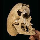 Los restos de un caballero de la Orden de Calatrava que padeció síndrome de Crouzon