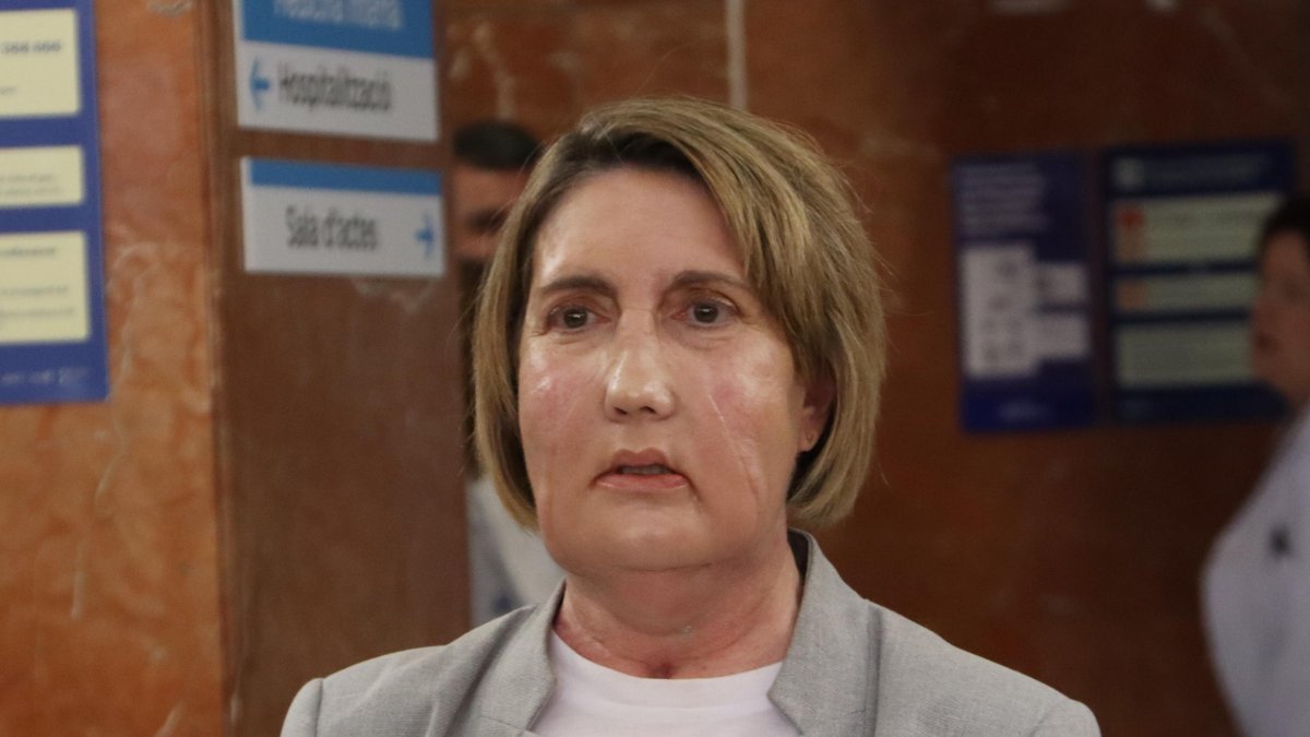 La Carme, ha recibido un trasplante de cara de una donante que falleció por eutanasia