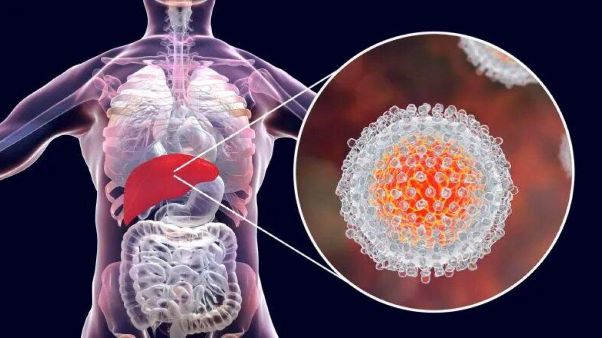La alarma por esta hepatitis surgió en Reino Unido, el país euro-peo con más casos, 111, por delante de España, con 22.