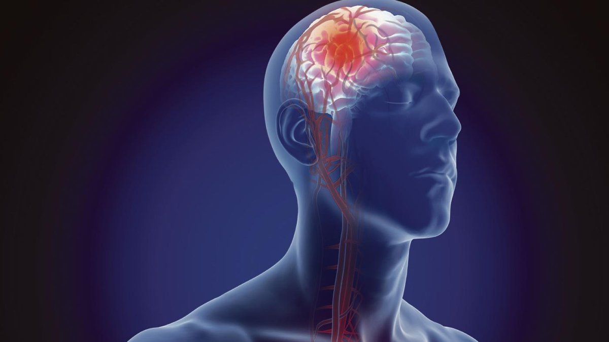 El ictus es la primera causa de discapacidad grave en Catalunya.