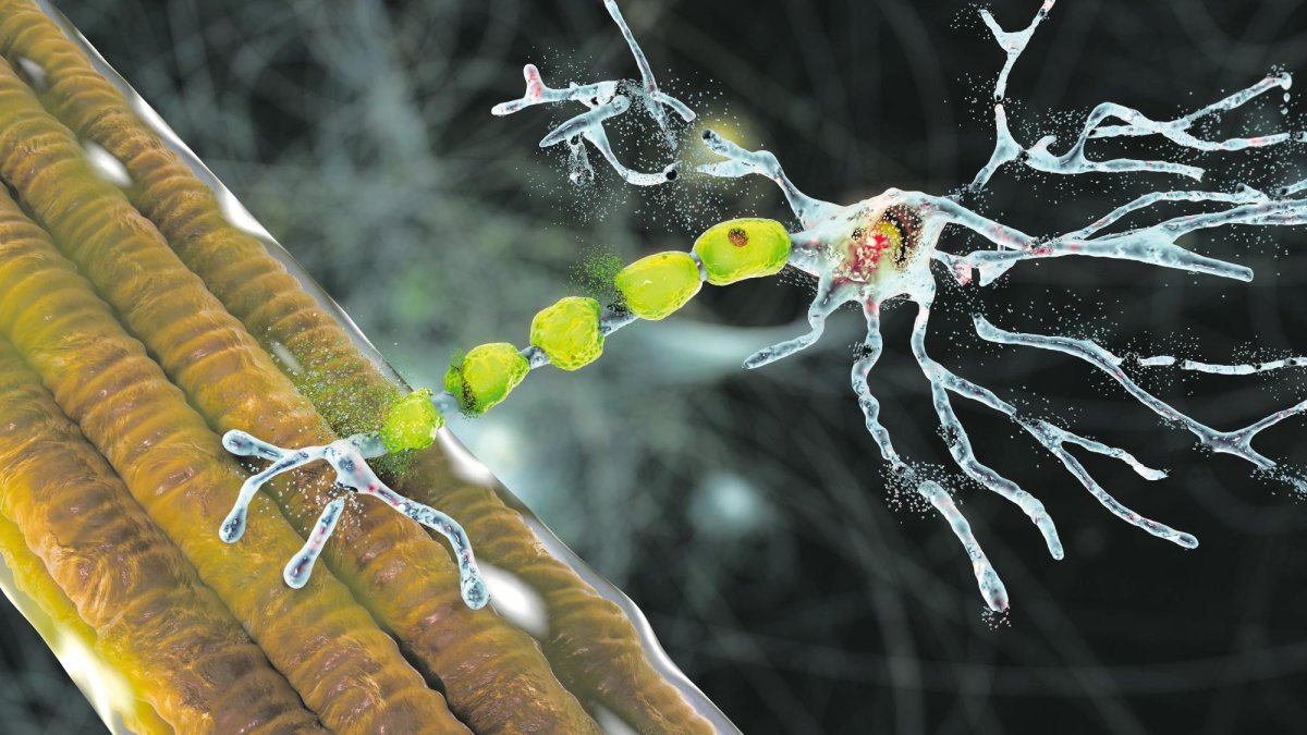 Ilustración conceptual de la degradación de las neuronas motoras, algo provocado por la ELA.
