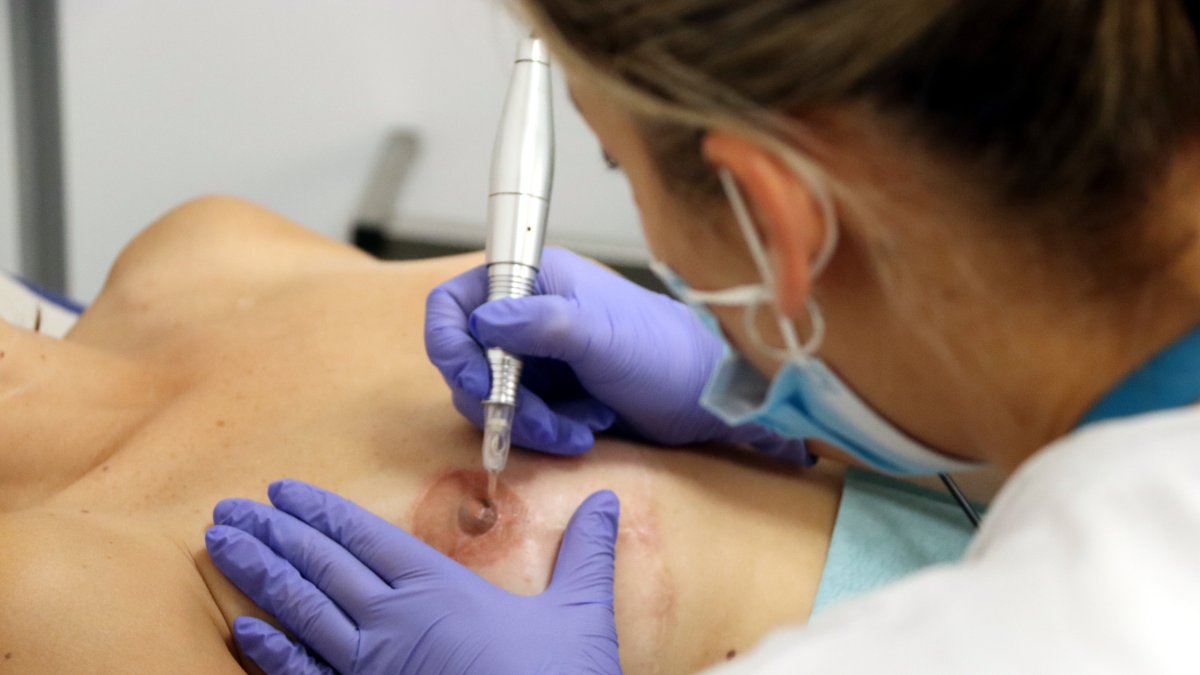 Una enfermera del Hospital de Igualada realiza la micropigmentación del pezón y la areola a Alba Segura