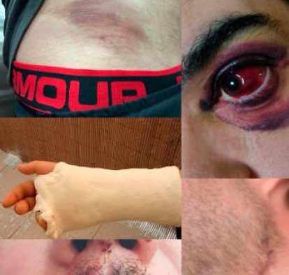 Algunas de las lesiones de funcionarios de prisiones en Catalunya. CSIF