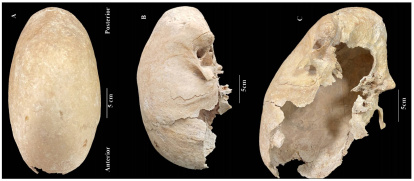 Vistas superior (A), lateral izquierda (B) e inferior (C) del neurocráneo del individuo